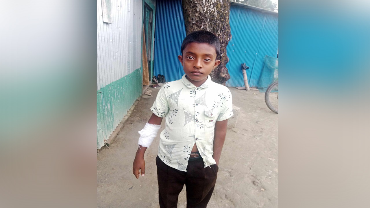 পাগলা কুকুরের কামড়ে আহত এক শিশু। ছবি : কালবেলা