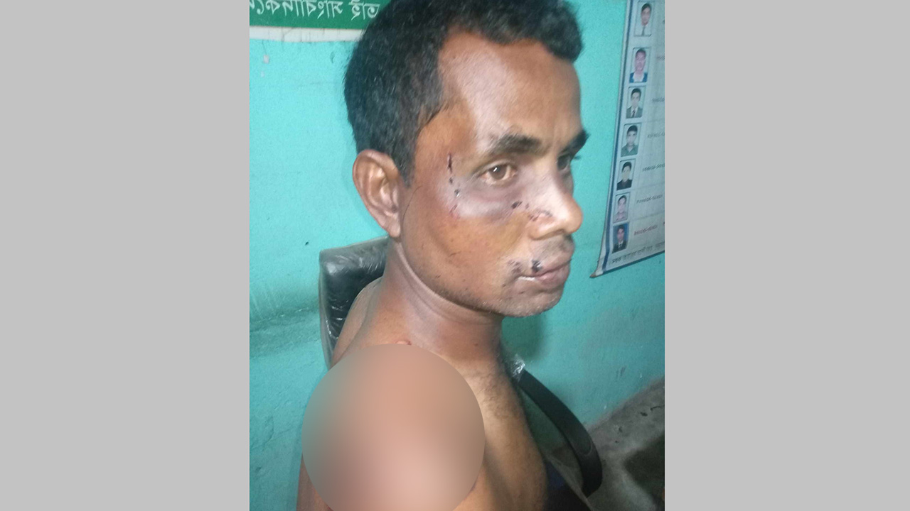 অপহৃত আবু তালেবকে আগুনে ঝলসানো শরীরে উদ্ধার করা হয়। ছবি : কালবেলা