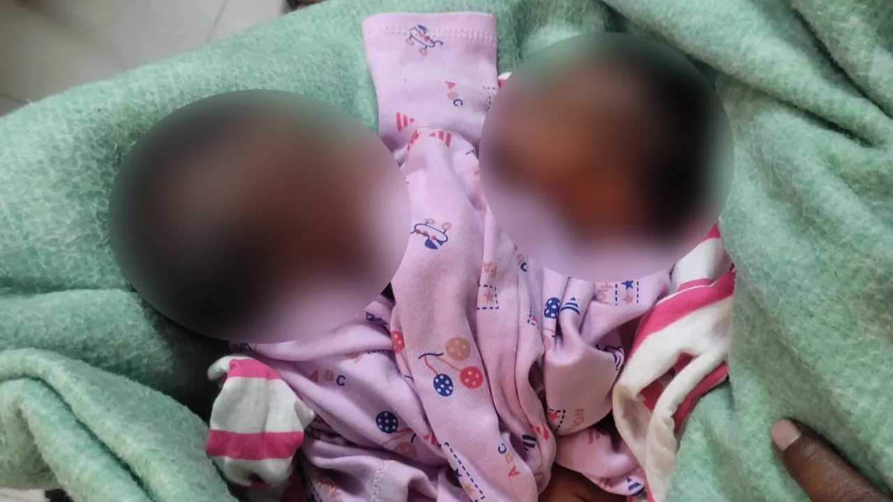 সদ্য জন্ম নেওয়া জোড়া লাগানো জমজ শিশু মায়মুনা ও মরিয়ম। ছবি : কালবেলা
