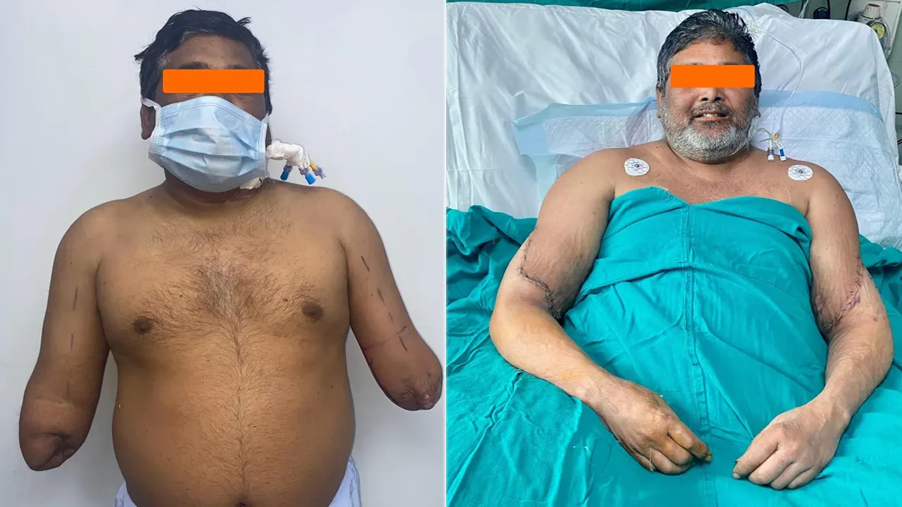 হাত প্রতিস্থাপন করার আগে ও পরের অবস্থা। ছবি : এনডিটিভি