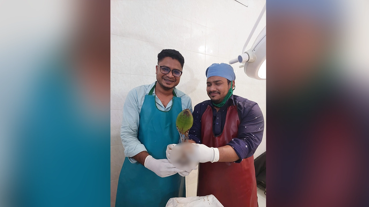 অপারেশন করে ডাব বের করেন চিকিৎসকরা। ছবি : কালবেলা