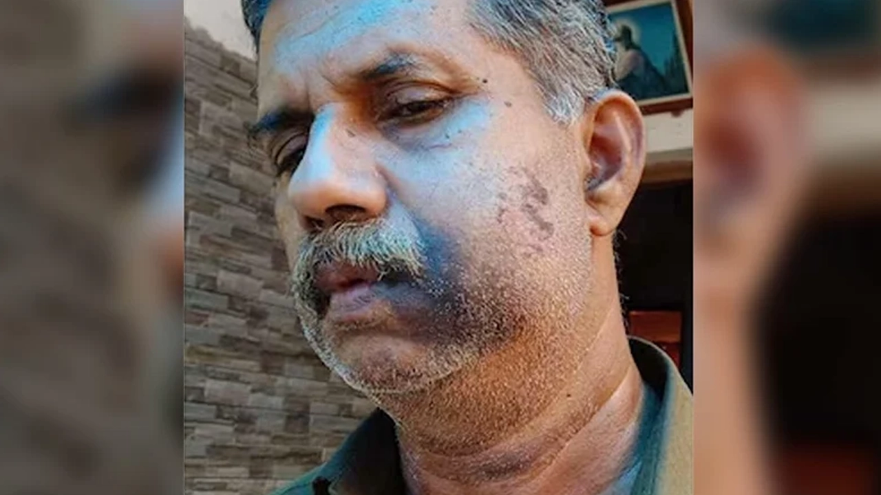 আঘাতের শিকার সহপাঠী ভি জে বাবু। ছবি: সংগৃহীত।
