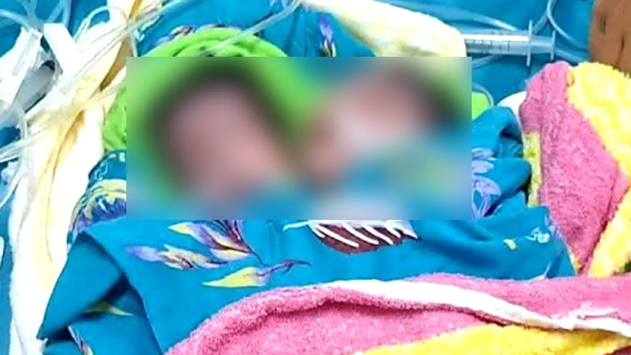 দুটি মাথা নিয়ে জন্ম হওয়া শিশু। ছবি : কালবেলা