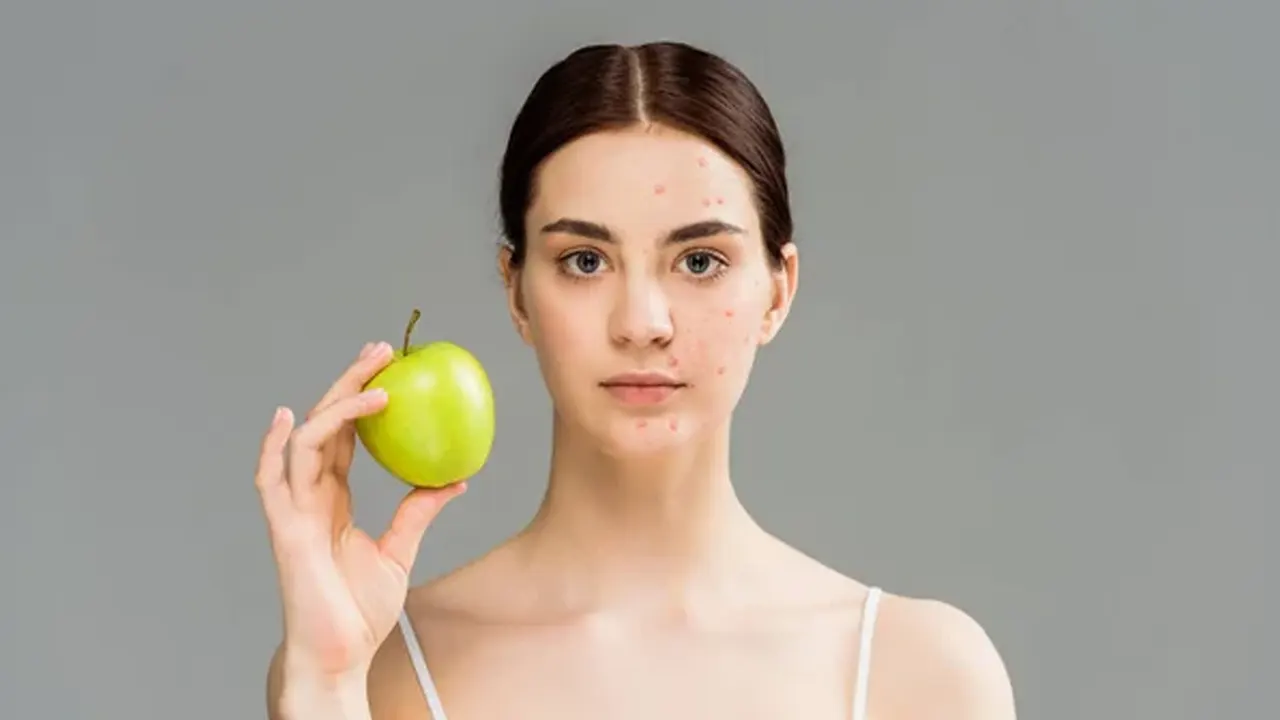ব্রণ কমাতে আপেল কি সত্যিই কাজ করে, জানুন চিকিৎসকের মত