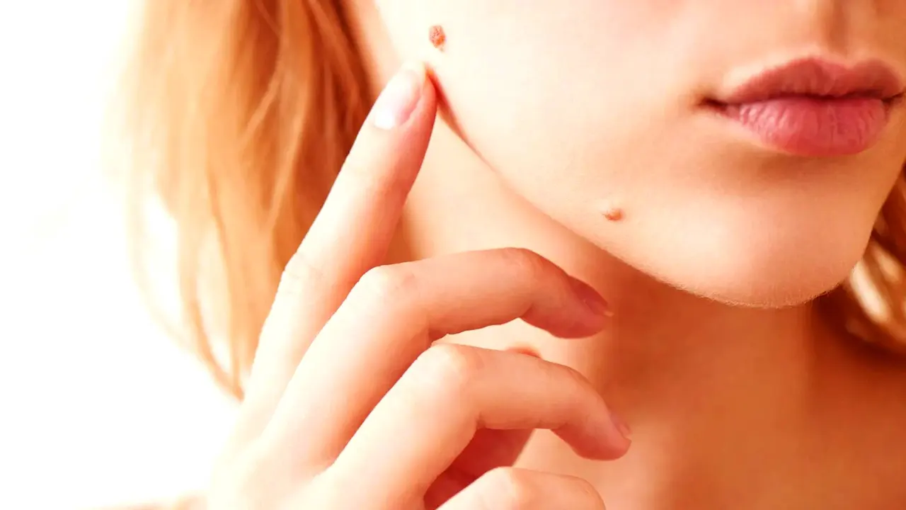 ঘরোয়া উপায়ে দূর করুন আঁচিল