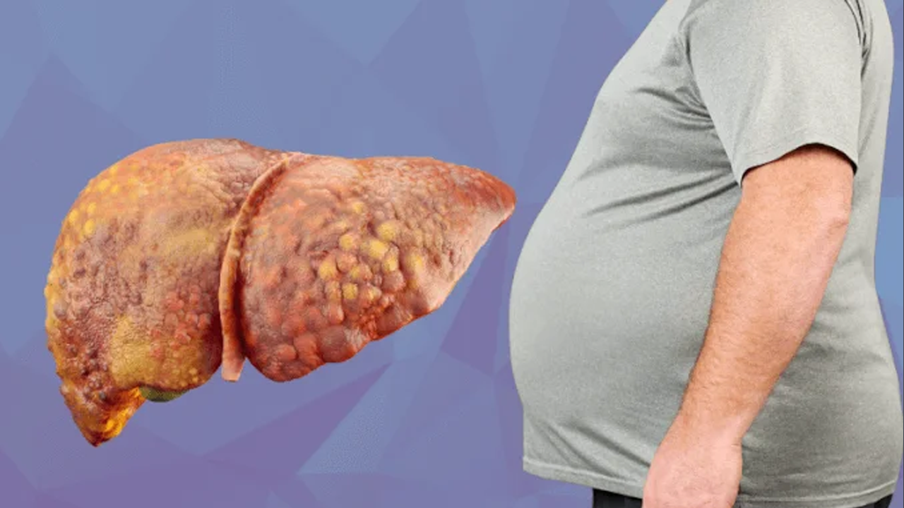 মাত্র ৬০ দিনে নির্মূল হবে ফ্যাটি লিভার, খাদ্য তালিকায় রাখুন এই  ৫ খাবার