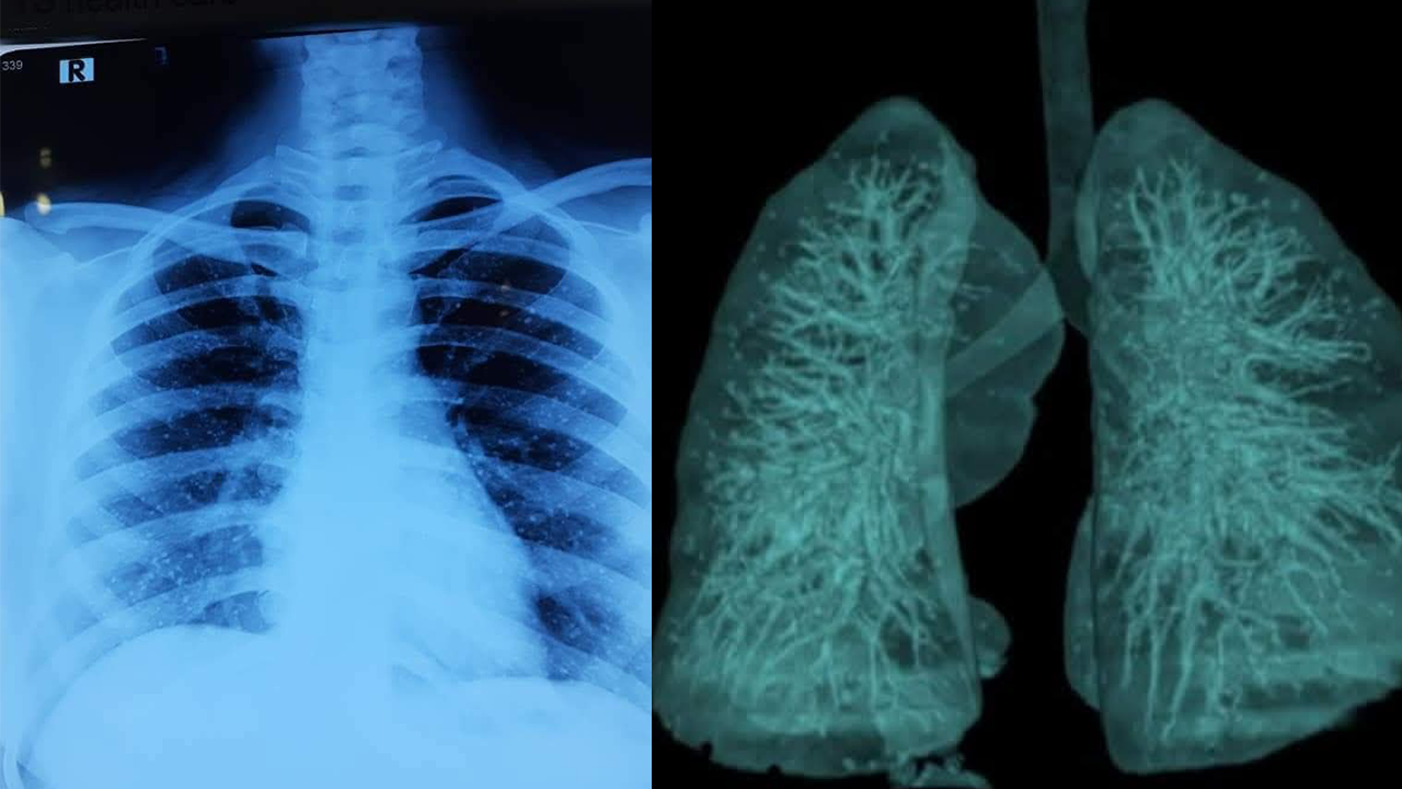 ফুসফুসে পাথর। ছবি : সংগৃহীত