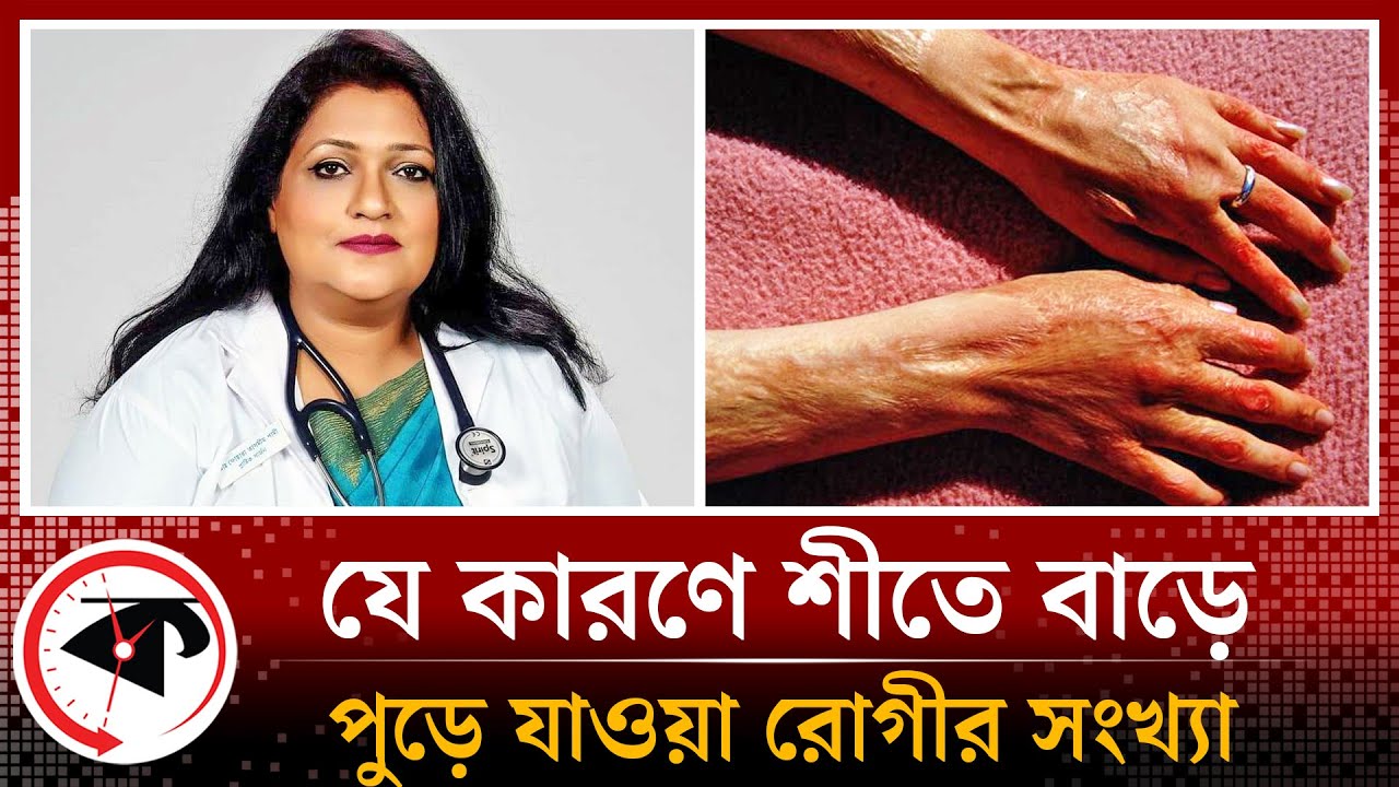 যে কারণে শীতে বাড়ে পুড়ে যাওয়া রোগীর সংখ্যা