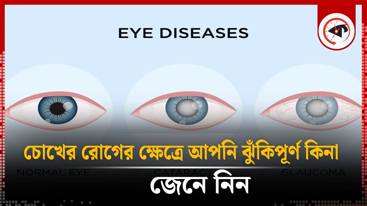 চোখের রোগের ক্ষেত্রে আপনি ঝুঁকিপূর্ণ কিনা, জেনে নিন